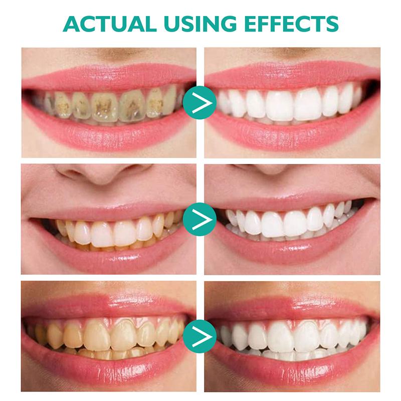 Teeth Whitening Mousse - Image 7